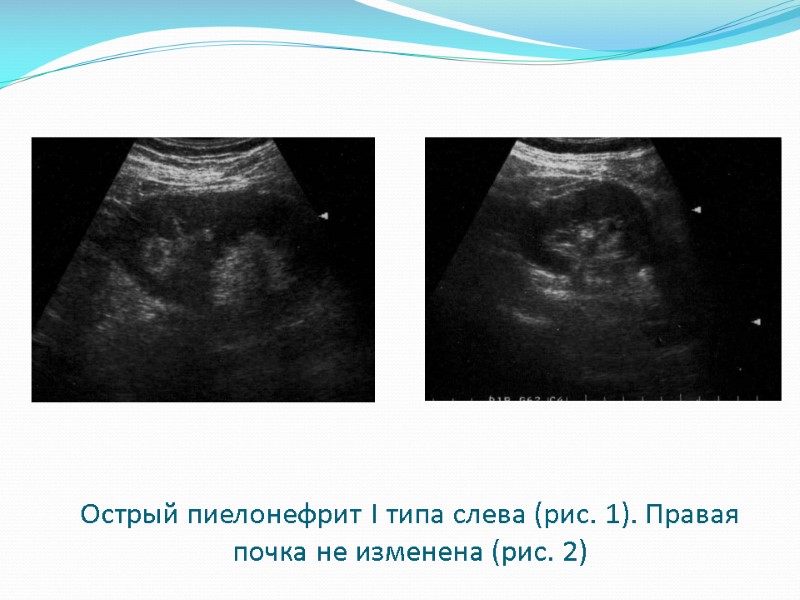 Острый пиелонефрит I типа слева (рис. 1). Правая почка не изменена (рис. 2)